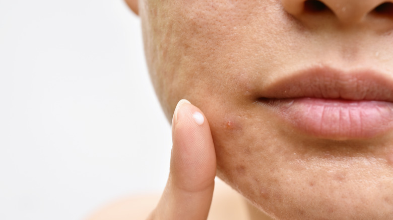 Acne and face skin problem, Woman applying acne cream medication, Topical pimple gel drug treatment.