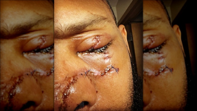 Justin Sutherland's facial injuries 